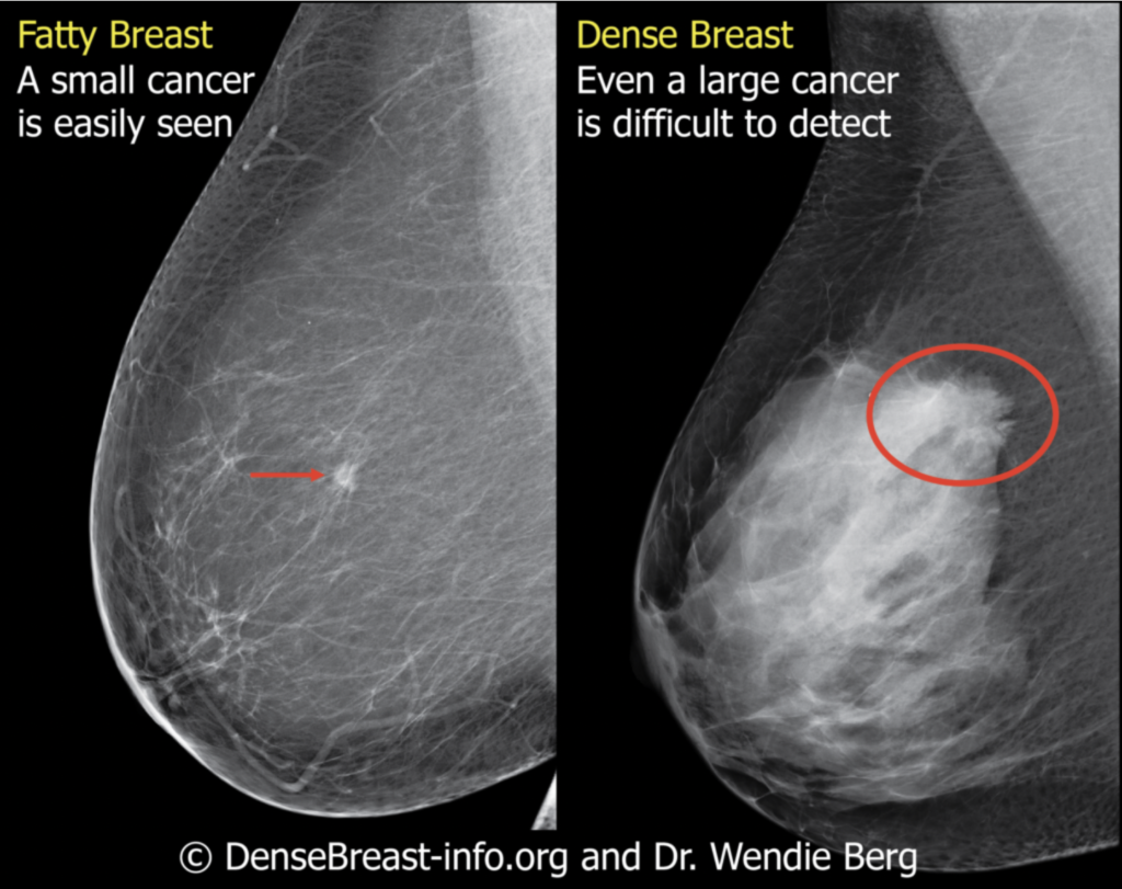 dense-breast-tissue-and-how-it-affects-you-erly-wellness